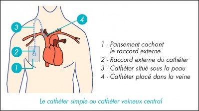 Catheter A Tige Creuse